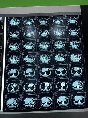 Blaue Laser-Radiographie-Wärmedruckfilm für medizinische Röntgengeräte