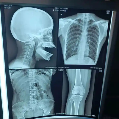200±5 μM Dicke medizinische Röntgenfilm für die Diagnose hoher Dichte
