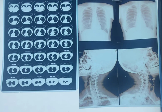High Printing Inkjet X-Ray Film Blau Film Dicke 210 Mikron Blau durchsichtig