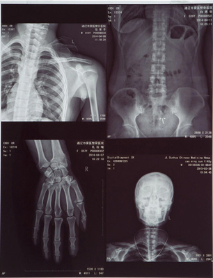Hochdurchsichtiges medizinisches Röntgenfilm FUJI DIHT 14*17in Lasertrockenbildfilm