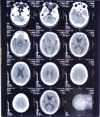 Hochdurchsichtiges medizinisches Röntgenfilm FUJI DIHT 14*17in Lasertrockenbildfilm