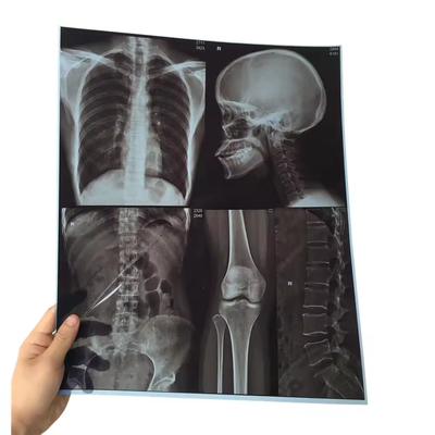 Dry Pix X-Ray Film Fuji DIHL X-Ray Medical Dry Laser Imaging X-Ray Film