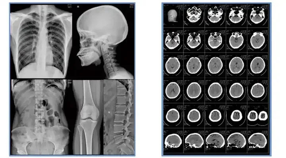 Blue Inkjet Medical X-Ray Film Medizinischer Trockenfilm A4 Blatt oder in Rollen Noch keine Bewertungen