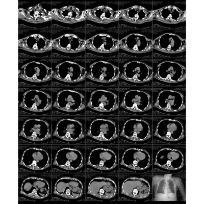 Erweiterte Blaue Laser-Druckbare Radiografische Laserfilm mit thermischem Druckverfahren
