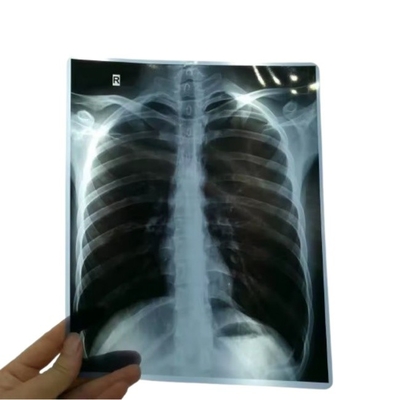 14*17 Zoll medizinischer Röntgen-/CT-/DR-Trocknscannerfilm für Röntgenlaser-Bilddrucker und Wärmebilddrucker